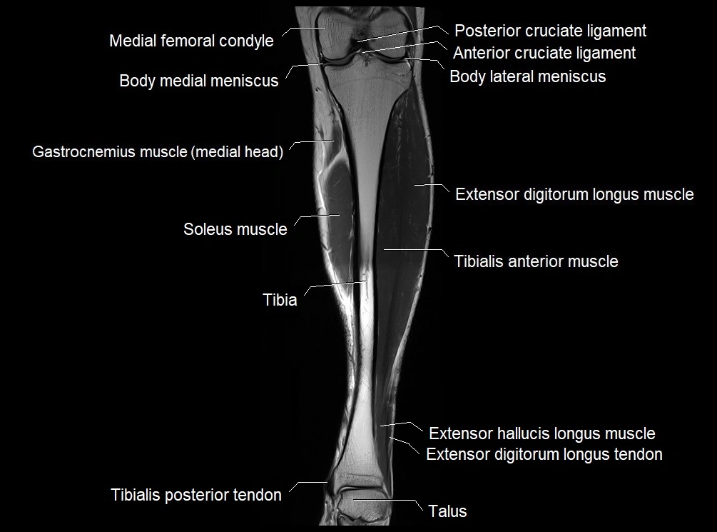MRI 3T leg (tibia & fibula) labelled coronal cross sectional anatomy image 13.webp